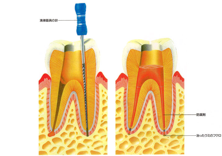 根管治療