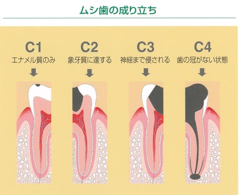 拡大治療、顕微鏡治療だと発見しやすいです