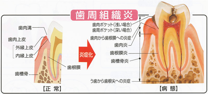 歯周組織炎