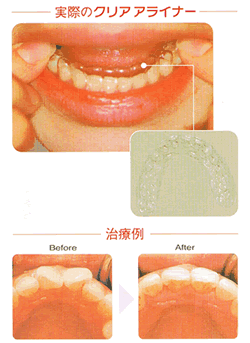 実際のクリアアライナー